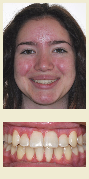 After orthodontic treatment