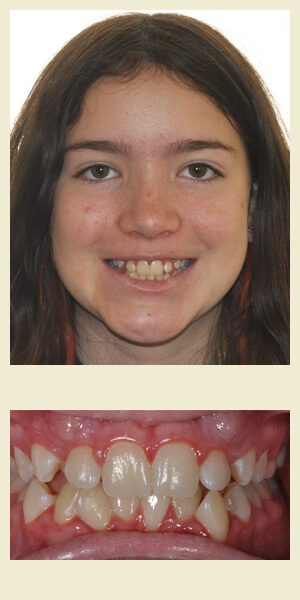 Before orthodontic treatment