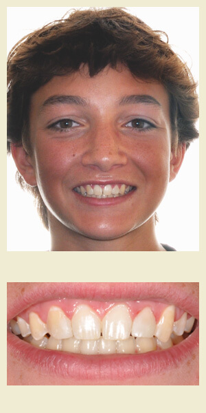 After orthodontic treatment