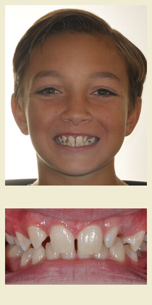 Before orthodontic treatment