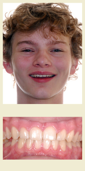 After orthodontic treatment