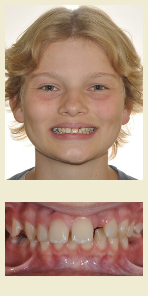 Before orthodontic treatment