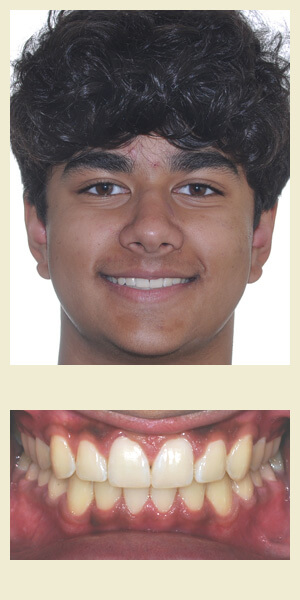 After orthodontic treatment