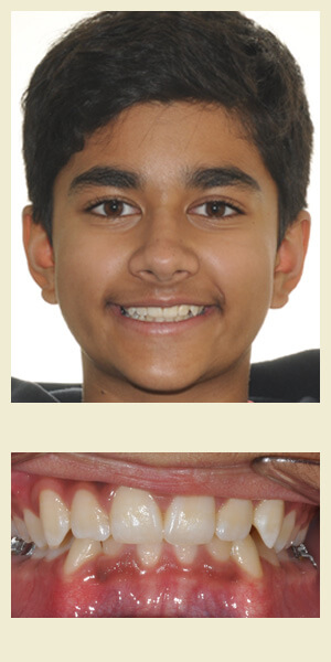 Before orthodontic treatment