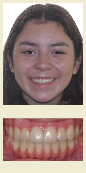 After orthodontic treatment