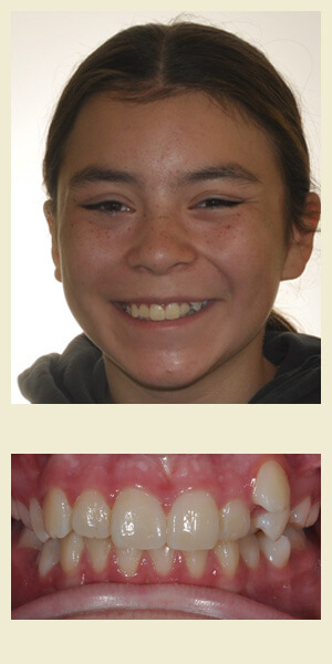 Before orthodontic treatment